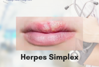 Herpes Simplex