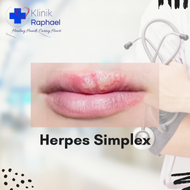 Herpes Simplex