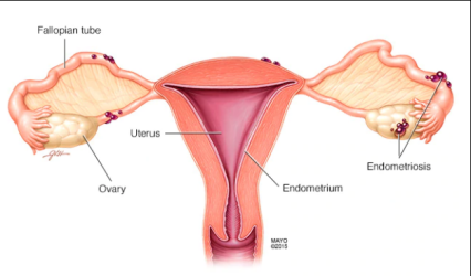 endometriosis