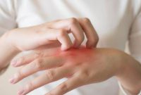 ilustrasi-gatal Moluskum kontagiosum