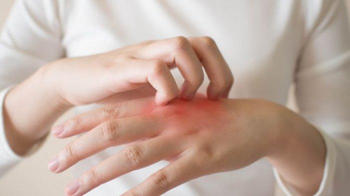 Moluskum kontagiosum