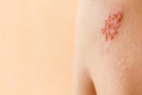 herpes-zoster herpes