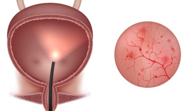 cystitis
