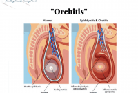 pengobatan-penyakit-orchitis