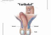 testis bengkak atau varikokel