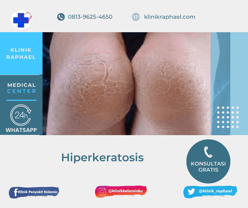 Hiperkeratosis Hiperkeratosis