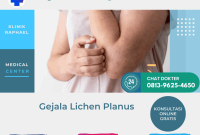 Lichen Planus Lichen Planus
