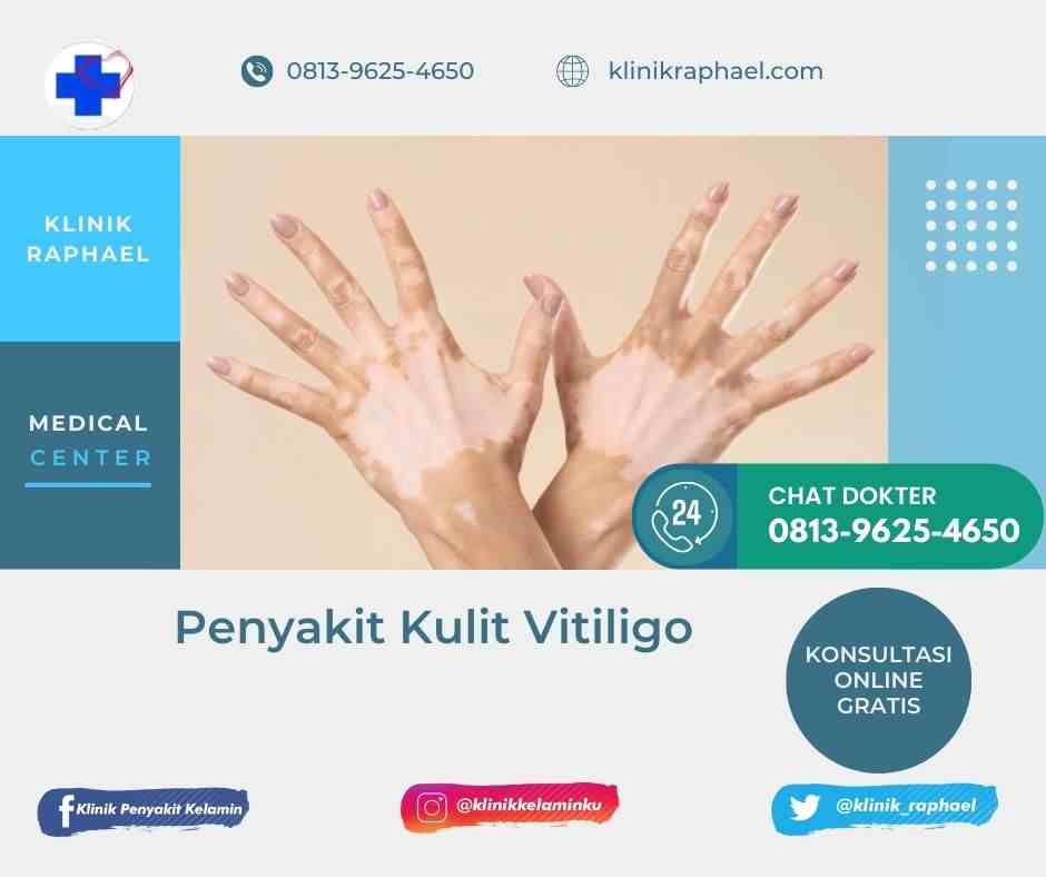 vitiligo