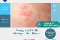 Mengobati kulit melepuh mengobati kulit melepuh