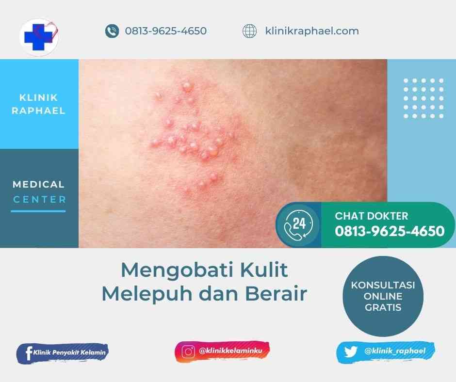mengobati kulit melepuh