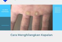 cara menghilangkan kapalan