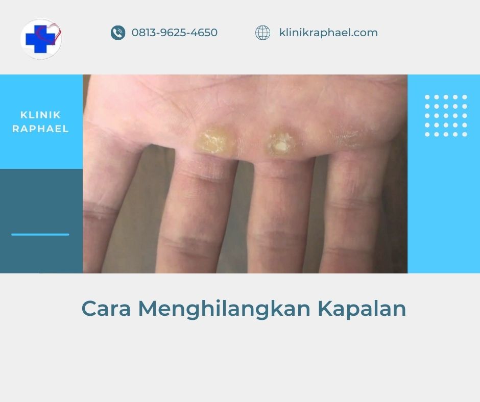 cara menghilangkan kapalan
