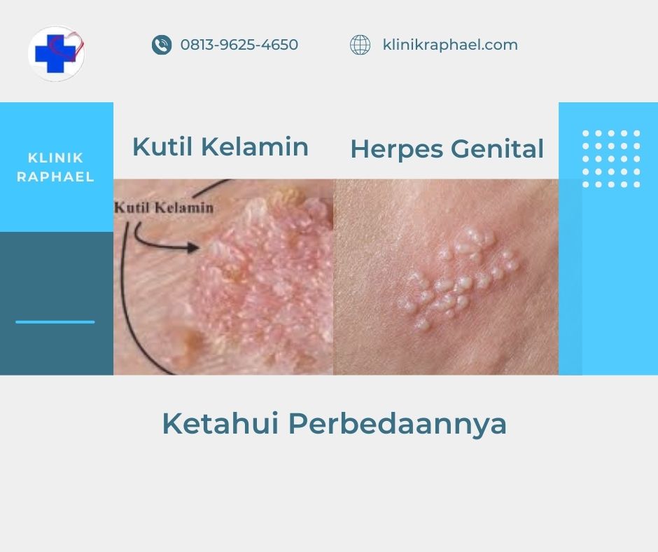 perbedaan-kutil-kelamin-dan-herpes-genital perbedaan kutil kelamin dan herpes kelamin