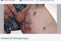 herpes-di-selangkangan penyebab herpes di selangkangan