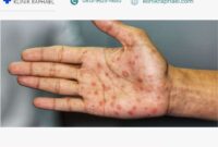 ruam-sifilis-ciri ruam sifilis ciri ciri lokasi