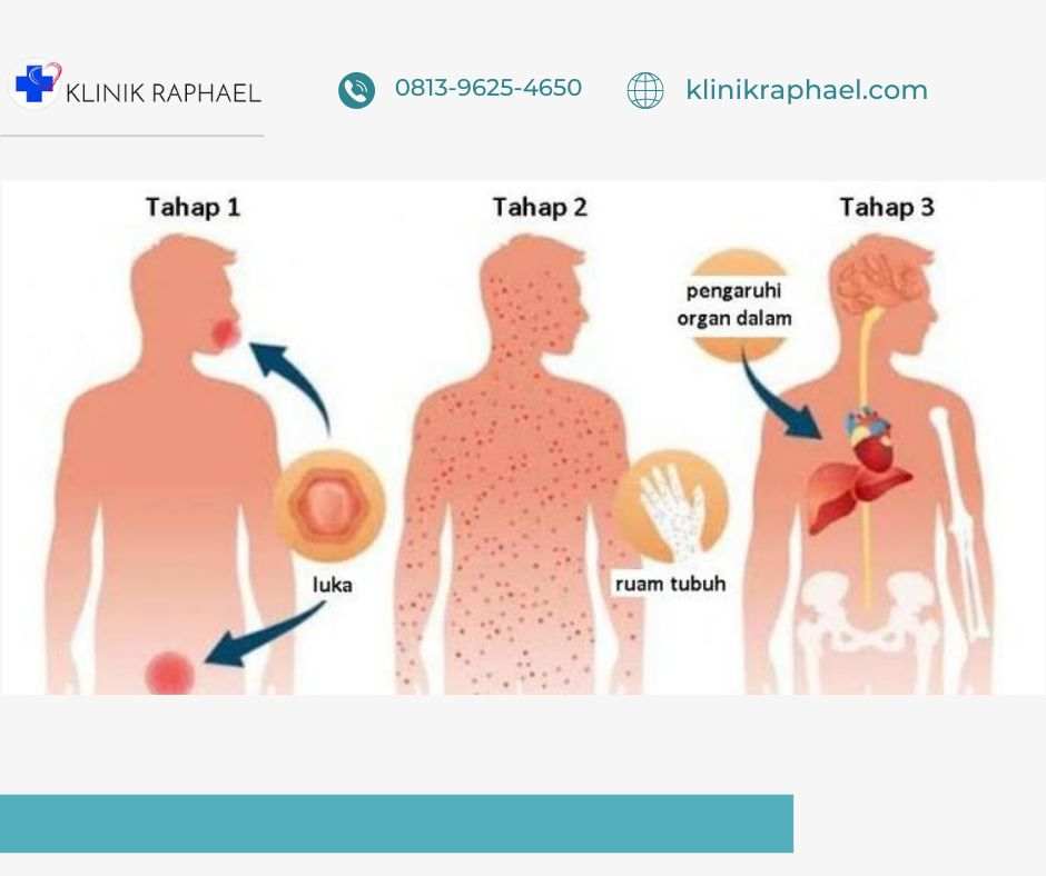 tahapan sifilis primer sekunder dan tersier