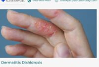 dermatitis-dishidrosis dermatitis dishidrosis