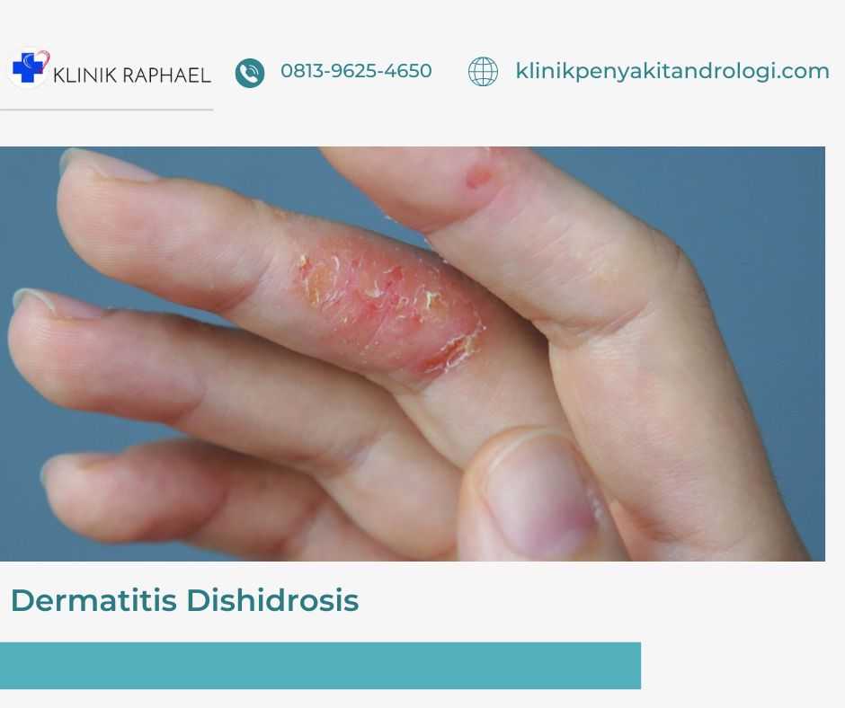 dermatitis dishidrosis
