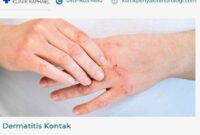 dermatitis-kontak dermatitis kontak