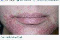 dermatitis-perioral-gejala dermatitis perioral