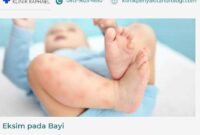 eksim-pada-bayi eksim pada bayi