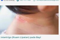 intertrigo-bayi intertrigo pada bayi