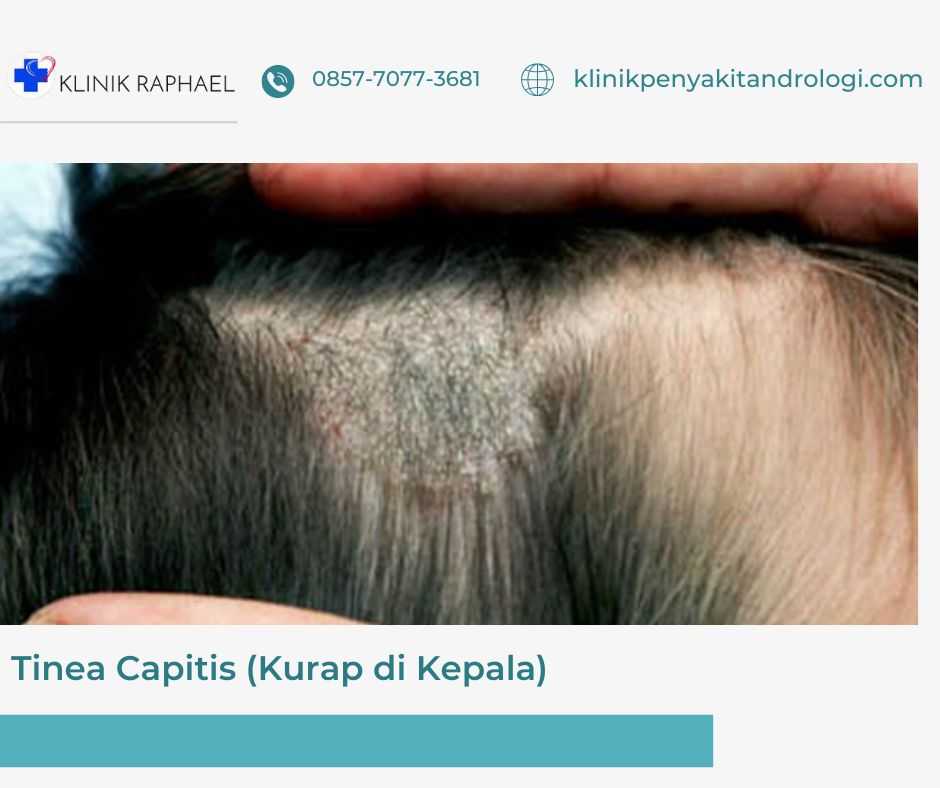 tinea-capitis-kurap tinea capitis kurap di kepala