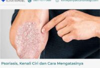 psoriasis psoriasis