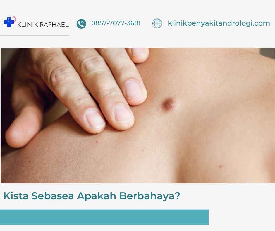 kista sebasea adalah