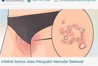 infeksi-jamur-penyakit-menular-seksual infeksi jamutr atau pms