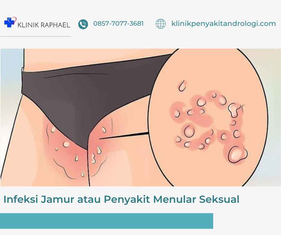 infeksi-jamur-penyakit-menular-seksual infeksi jamutr atau pms