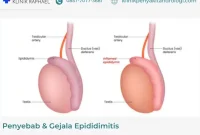 gejala-epididimitis
